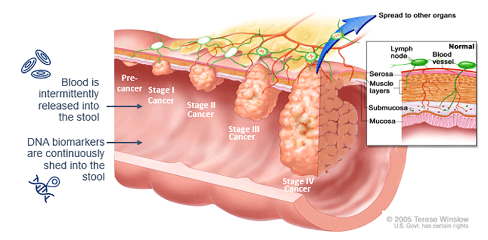 Illustrated cross-section of the colon showing progression of colorectal cancer from precancerous growth to stage 4 cancerous growth. Accompanying text within the image says blood is intermittently released into the stool and that DNA biomarkers are continuously shed into the stool. 